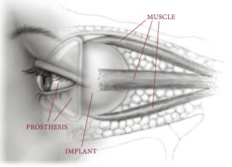 enucleation_eviseration