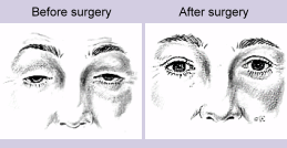 img-ptosis-bef-aft