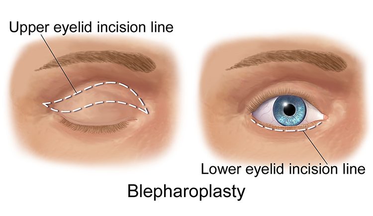 An image of upper eyelid incision line for Blepharosplasty Cosmetic Eyelid Surgery