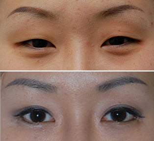 East Asian Blepharoplasty before and after photo